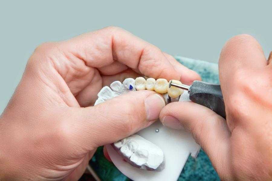 Riparazione dentiera immediata Napoli Vomero - Estetica Dentale Napoli